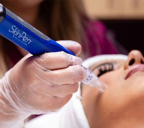 Skin pen microneedling treatments
